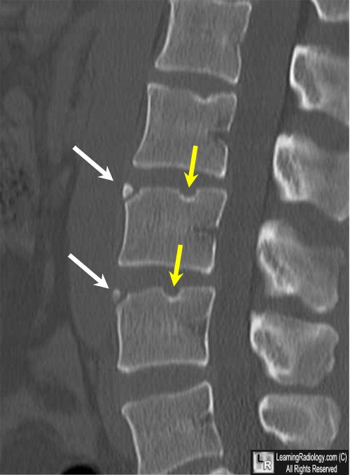 limbus vertebra fracture discitis learningradiology